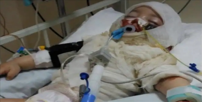 Aksaray´da Üzerine kaynar su dökülen 9 aylık bebekten sevindirici haber geldi