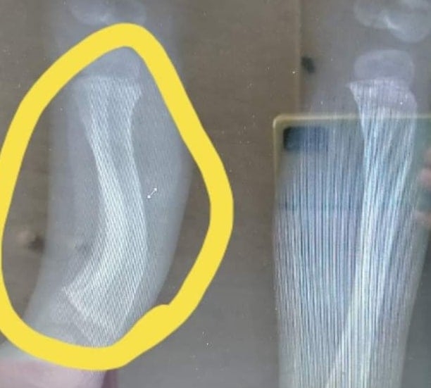 Küçük Osman Ameliyat İçin Yardım Bekliyor