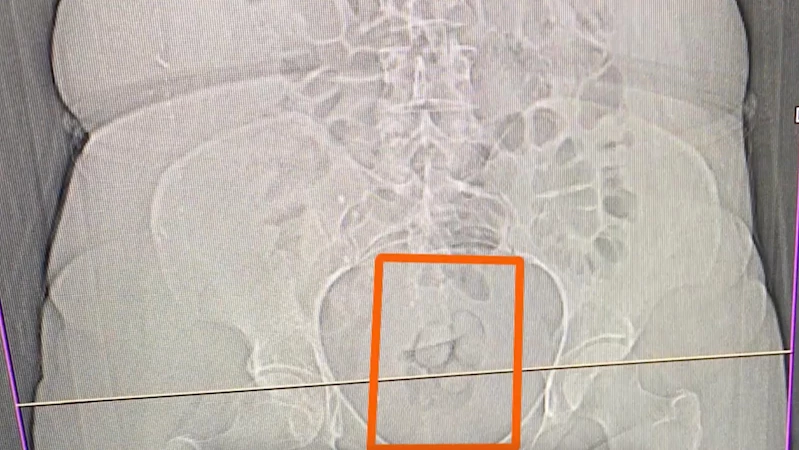 Erzincan- Midesinden 21,39 gram metamfetamin çıktı /Video eklendi 