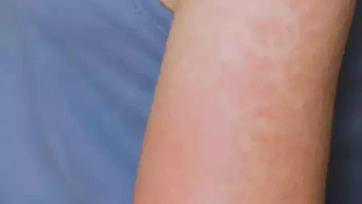 ABD’nin Kansas eyaletinde 23 kızamık vakası bildirildi