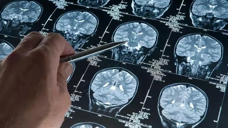 Uyku ilacı, Alzheimer ile ilişkili proteinlerin birikimini azaltabilir
