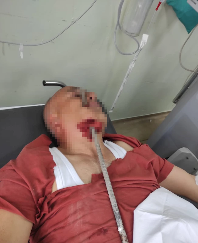 Şantiyede ayağı kayıp düşen işçinin yüzüne inşaat demiri saplandı