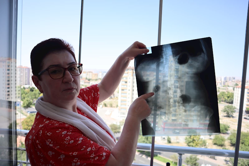 Kayseri - 22 yıldır karnında ameliyat iğnesiyle yaşıyor /Video eklendi 