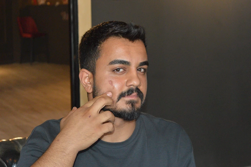 Lazer epilasyonda yüzü yandı, işletme hakkında şikayetçi oldu