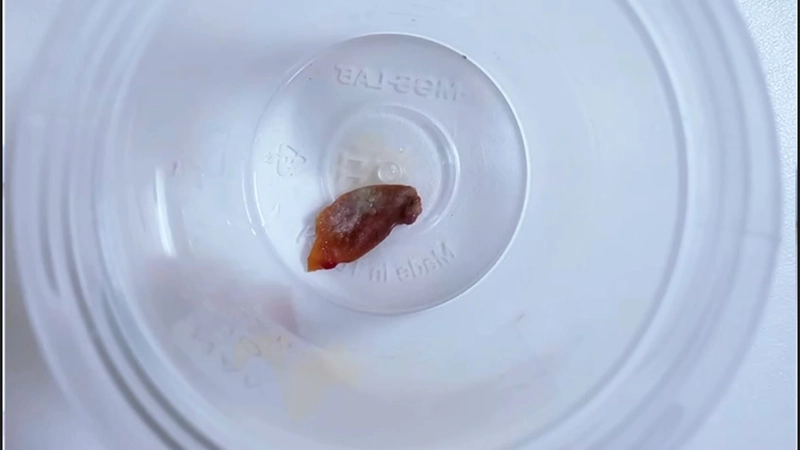 1,5 yıllık öksürüğün nedeni, kabak çekirdeği çıktı 